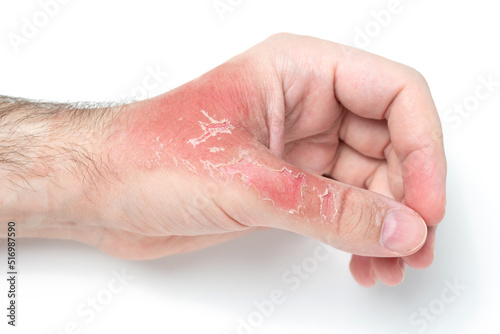 Man's hand with injuries and red dead skin on hand after thermal burn, domestic accident, careless behavior with boiling water on white background. Damage to hand after bursting glass with hot water.