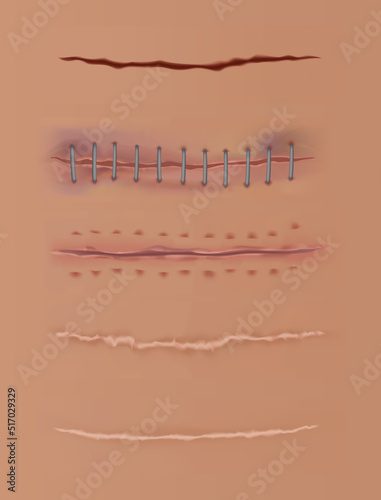 Healing wounds set, skin scars, stitched gash and cuts. Realistic surgical sutures, stitched wounds at different healing stages on human skin background