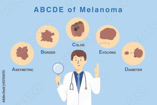 Doctor holding magnifies glass with 5 characteristics of skin damage from cancer cell. Illustration about diagnosis and classification of melanoma by use ABCDE letter.
