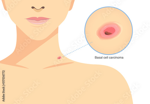Red bump is Basal cell carcinoma on the woman's neck. Illustration about skin cancer, medical and health checks.