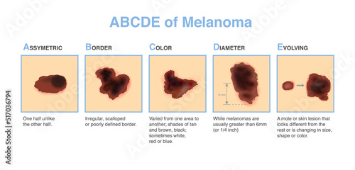 Different characteristics of skin damage. ABCDE stands for asymmetry, border, color, diameter, and evolving. Medical diagram for diagnosing and classifying melanomas and treatment.