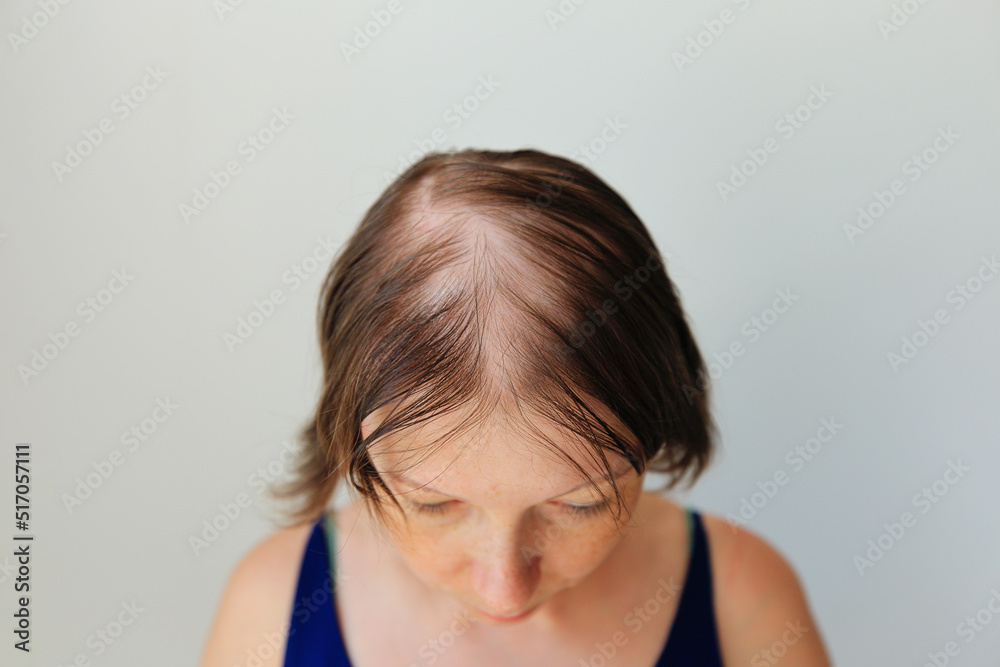 Hair loss in the form of alopecia areata. Bald head of a woman. Hair thinning after covid. Bald patches of total alopecia Hair loss in the form of alopecia areata. Bald head of a woman. Hair thinning after covid. Bald patches of total alopecia