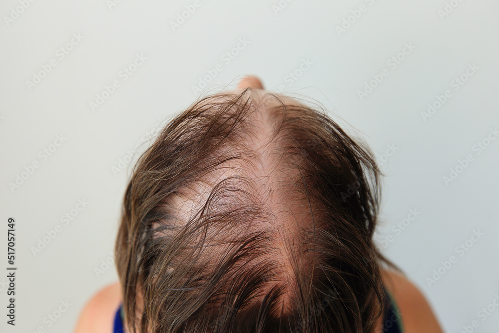 Hair loss in the form of alopecia areata. Bald head of a woman. Hair  thinning after covid. Bald patches of total alopecia Stock Photo | Adobe  Stock