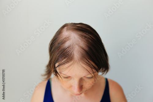 Hair loss in the form of alopecia areata. Bald head of a woman. Hair thinning after covid. Bald patches of total alopecia