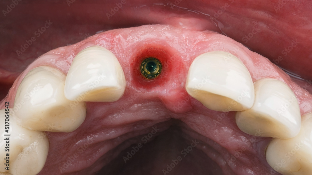 excellent dental view on the abutment in the gum cavity for installing the crown of the central tooth