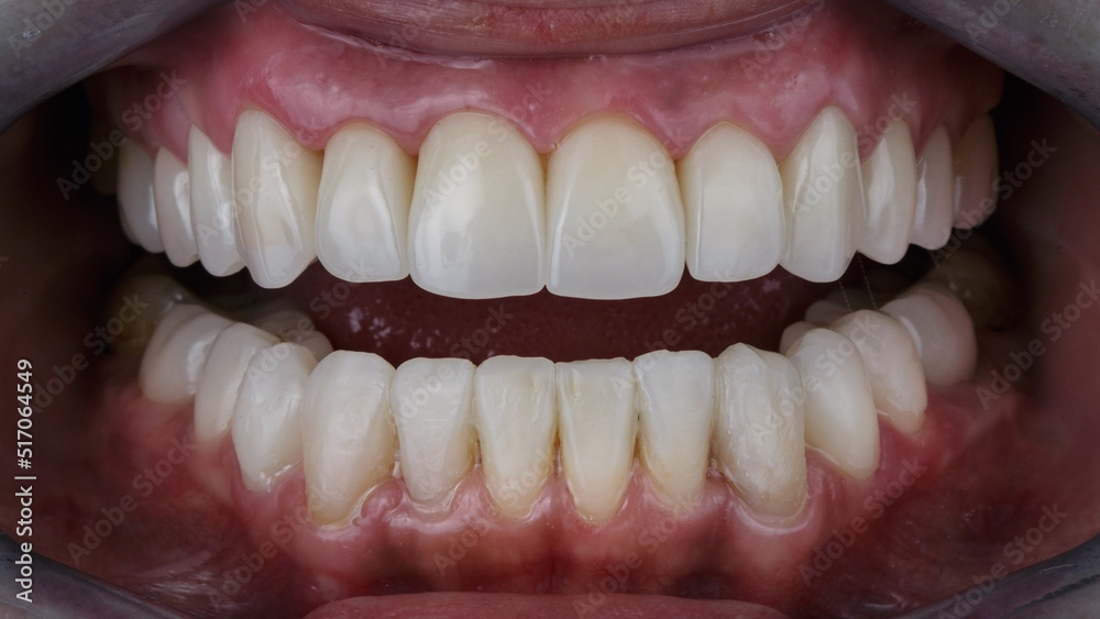 two jaws with open ceramic crowns two jaws with open ceramic crowns