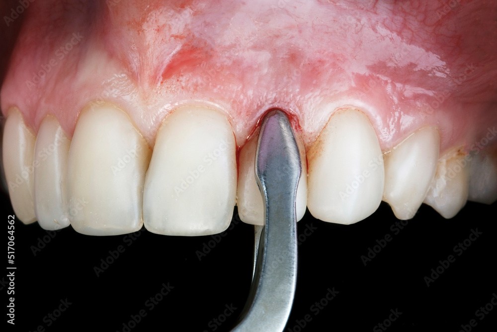 tooth extraction with dental elevator Stock Photo Adobe Stock
