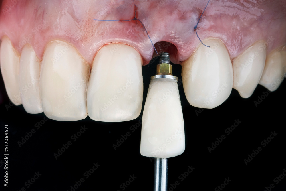 installation of a dental crown after implantation on a black background