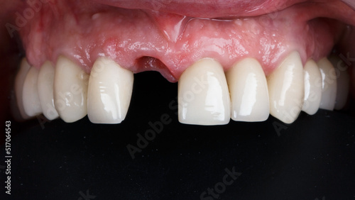 upper jaw without a central tooth before prosthetics on a black background
