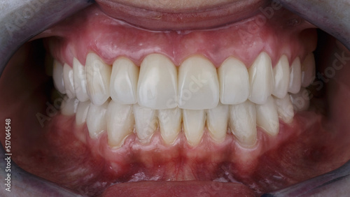 dental photo of two jaws with ceramic crowns in the bite