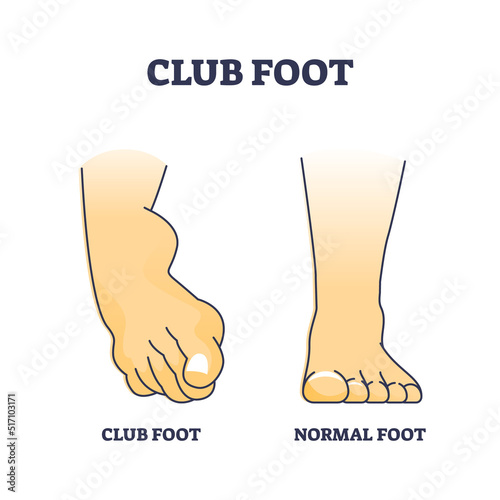 Club foot or talipes for baby that feet turn in and under outline diagram. Labeled educational medical comparison with clubfoot and normal condition vector illustration. Disorder with leg curvature.