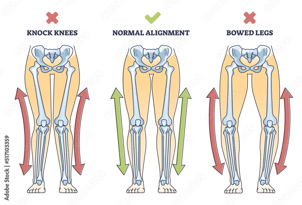 Vecteur Stock Bowed legs syndrome with normal and knock legs comparison ...