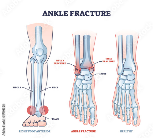 Ankle fracture and right foot anterior trauma medical view outline diagram. Labeled educational scheme with anatomical comparison for healthy and fractured bones vector illustration. Leg tibia injury