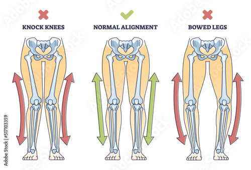 Bowed legs syndrome with normal and knock legs comparison outline diagram. Labeled educational physical defect with outward bending and knees does not touch vector illustration. Anatomical explanation photo