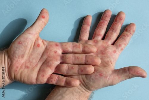 Male hands with Monkeypox rash. Patient with MonkeyPox viral disease. Close Up of Painful rash, red spots blisters on the skin. Human palm with Health problem. Banner, copy space. Allergy, dermatitis photo