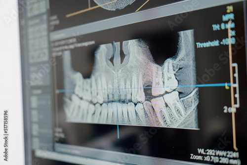 X-ray of the jaw with teeth on a computer monitor. Examination of the oral cavity using digital, medical equipment.