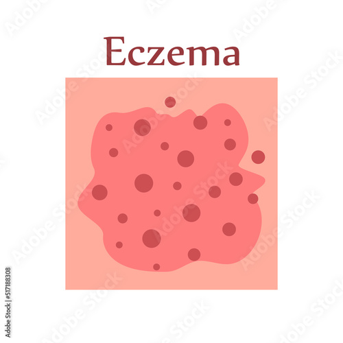 Eczema on human skin. Dermatological disease. The symptom is itching, pain, redness and rash. Allergic reaction. Medical diagnostics and treatment. Vector illustration