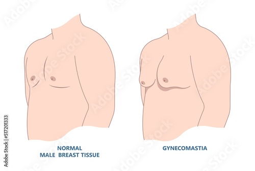 Breast cancer with Gynecomastia Man Obesity with fat tissue on the chest comparison with normal the disorder in medical