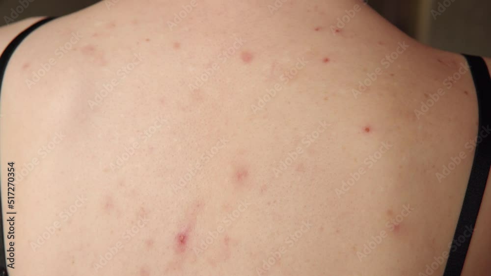 Women's back in pimples and spots, dermatological problems, skin care concept. Women's back in pimples and spots, dermatological problems, skin care concept.