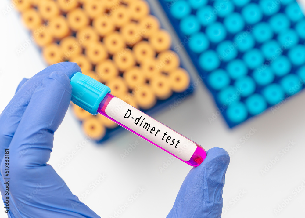 Blood sample test tube for Ddimer test, diagnosis for intravascular thrombosis after COVID19