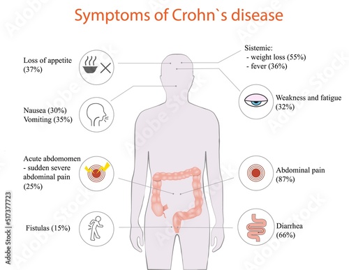 Vector illustration of Crohn`s disease symptoms