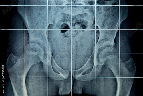 radiografia photo