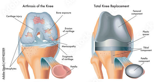 Medical illustration shows an arthrosis of the knee and total knee replacement, with annotations.