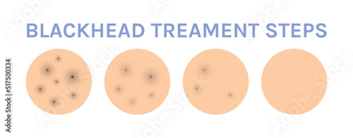 Facial Blackhead on Human Skin. Problem Skin Treatment. Step. Dirty and Healthy Clear Skin. Before and After. Color Realistic style. White background. Vector illustration for Beauty and Medical Design