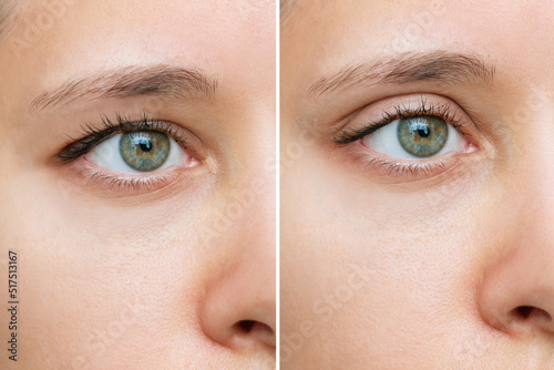 Close up of a young caucasian woman's face with drooping upper eyelid before and after blepharoplasty isolated on white background. Result of plastic surgery. Changing the shape, cut of the eyes photo