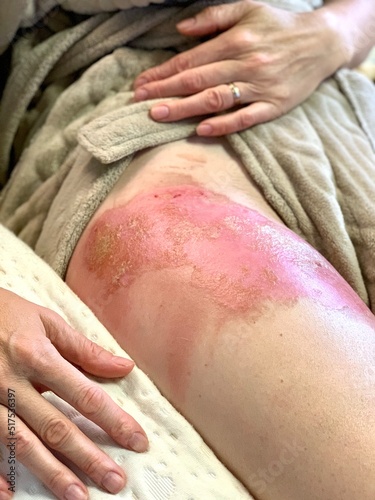 Burn wound skin. Severe burns.
