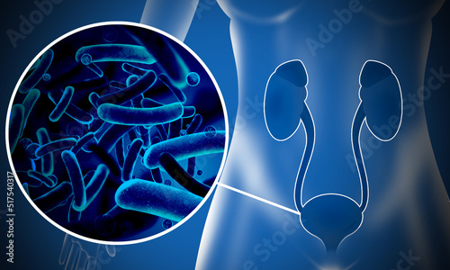 Illustration of woman suffering from cystitis. Urinary infection