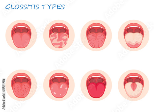 Types glossitis. Inflammatory disease tongue, vector illustration