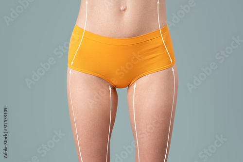 Hip, abdomen liposuction, fat and cellulite removal concept, female body with painted surgical lines photo