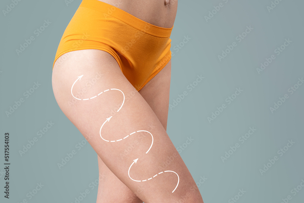 Hip liposuction, fat and cellulite removal concept, skinny female body with painted surgical lines - obrazy, fototapety, plakaty 