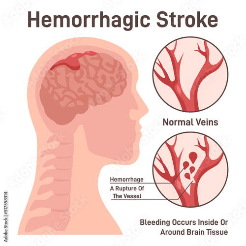 Hemorrhagic brain stroke concept. Hemorrhage in the brain, rupture