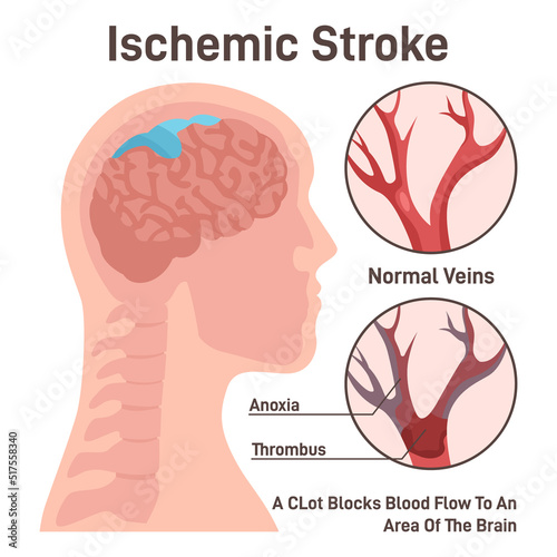 Ischemic brain stroke concept. Thrombus in the cerebral artery