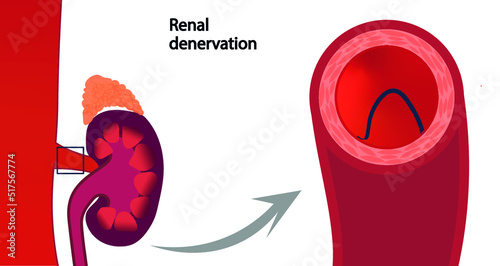 Renal denervation illustration. RDN treatment for hypertension. Renal artery cross section view photo