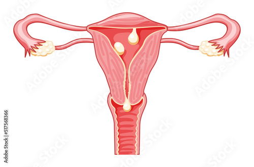 Polyps in the uterus - cervical, pedunculated and sessile Female reproductive system in cross sections. Front view in a cut. Human anatomy diseases internal organs location scheme flat style icon photo