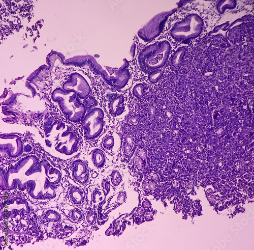 Microscopic image of Gastric carcinoid tumor, rare tumors that develop within the gastric mucosa. Neuroendocrine tumor (NET), which presented as a gastric polyp photo