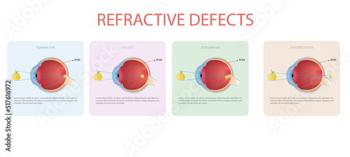 Refractive errors of vision,myopia,hyperopia,astigmatism photo