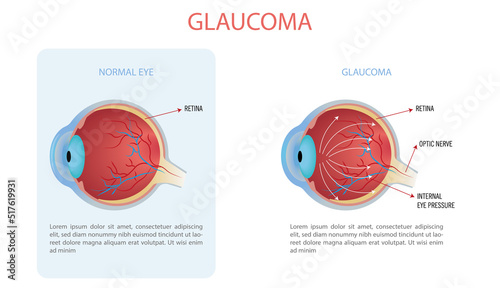 Infographic of a normal eye and an eye with glaucoma, the arrows indicate the internal pressure of the eye.