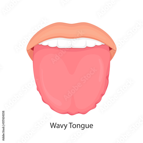 Fototapeta swollen enlarged white tongue with wavy ripple scalloped edges (medical name is