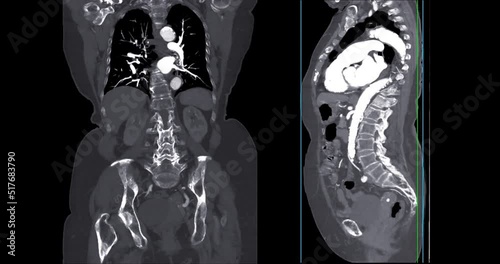 CTA whole aorta for diagnonsis aortic aneurysm. photo