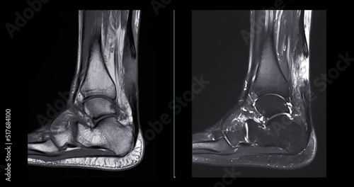 mri ankle joint sagittal T2 for diagnosis tendon of ankle joint injury. photo