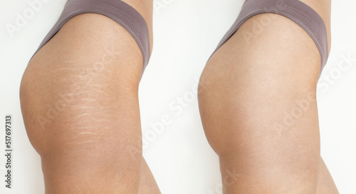 stretch marks before and after
Hips after stretch mark removal treatment photo