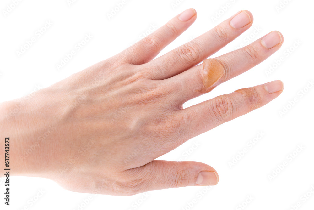 Close-up of the water blister on the finger on a white background. - obrazy, fototapety, plakaty 