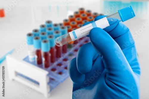 Blood sample of patient for complete screening test in laboratory. doctor with Blood tube and catheter photo