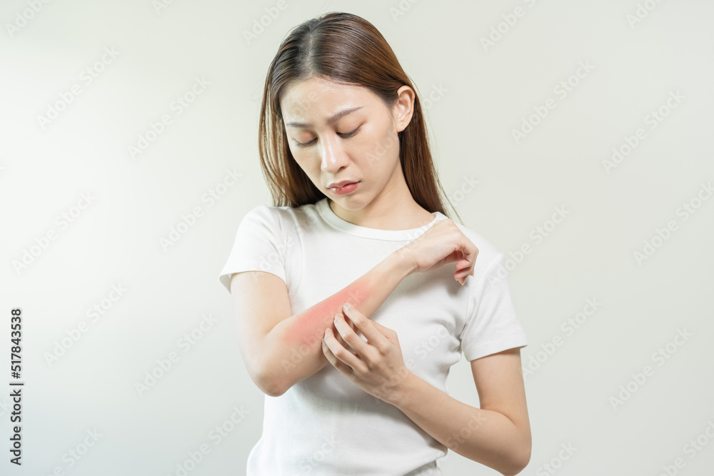 Dermatology asian young woman, girl allergy, allergic reaction from atopic, insect bites on her arm, hand in scratching itchy, itch red spot or rash of skin. Healthcare, treatment of beauty. Dermatology asian young woman, girl allergy, allergic reaction from atopic, insect bites on her arm, hand in scratching itchy, itch red spot or rash of skin. Healthcare, treatment of beauty.