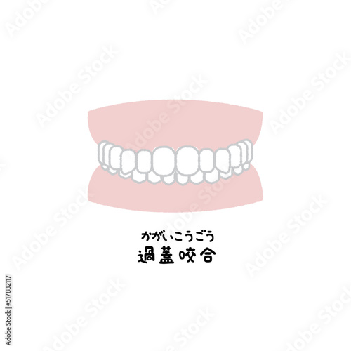 過蓋咬合　歯並び　イラスト