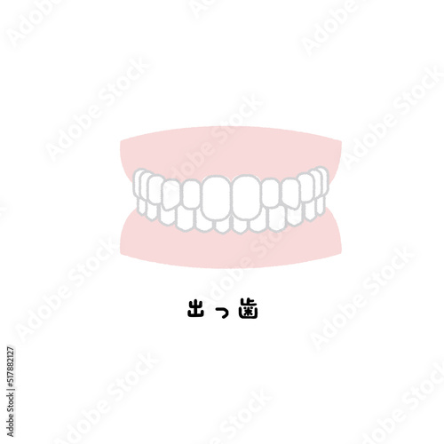 出っ歯　歯並び　イラスト